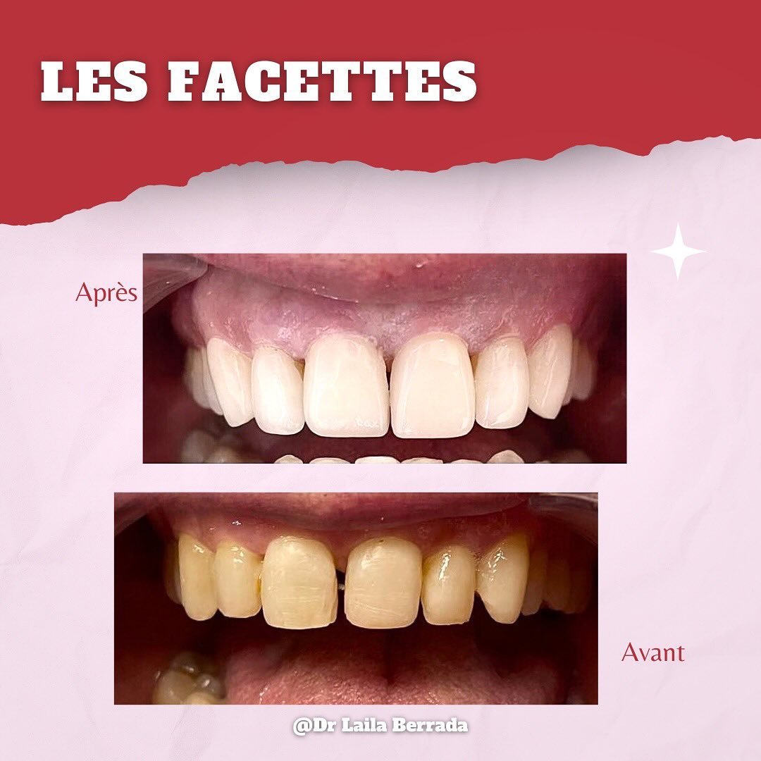 Transformation de sourire - Cas 5